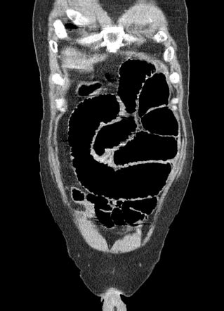 pegogram|Radiopaedia.org